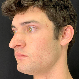 Male patient profile with clear skin, showcasing natural facial contours.