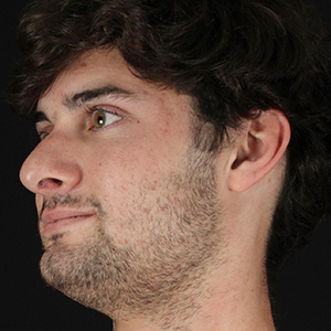 Male patient profile showcasing facial features for cosmetic consultation.