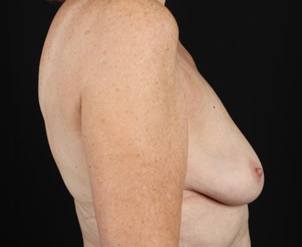 Side profile of a woman post-breast augmentation, showcasing natural results.