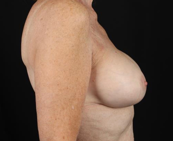 Breast augmentation results highlighting natural contours and professional care.