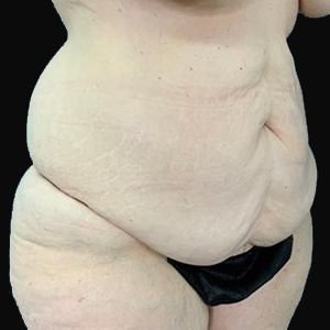 Body contouring results highlighting skin texture and shape after surgery.