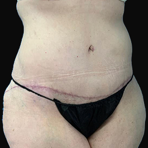 Post-surgery abdomen with visible scarring, showcasing Lentz Plastic Surgery results.
