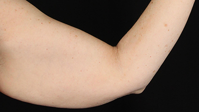 Smooth, toned arm highlighting Lentz Plastic Surgery's body contouring expertise.