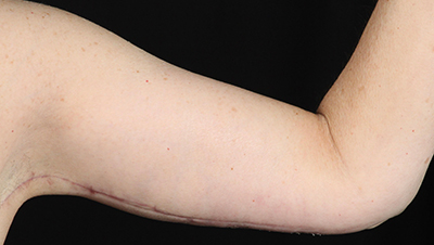 Post-surgery arm with healing incision, showcasing Lentz Plastic Surgery expertise.