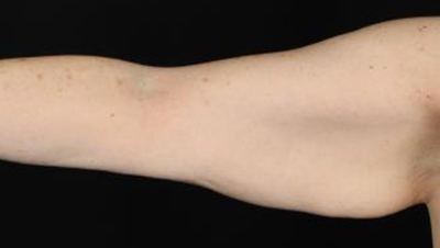 Smooth, toned arm showcasing results of Lentz Plastic Surgery procedures.
