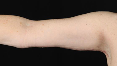 Before-and-after arm contouring results at Lentz Plastic Surgery.