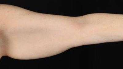 Smooth, toned arm highlighting Lentz Plastic Surgery's body contouring expertise.