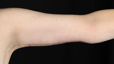 Before-and-after arm contouring results from Lentz Plastic Surgery.