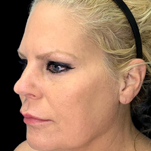 Profile view of a woman showcasing refined facial features post-surgery.