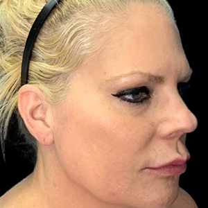 Profile view of a woman showcasing refined facial aesthetics after surgery.