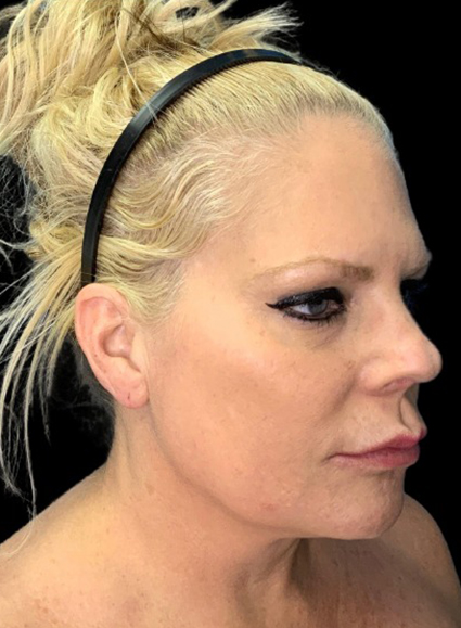 Profile view of a woman showcasing refined facial features post-surgery.