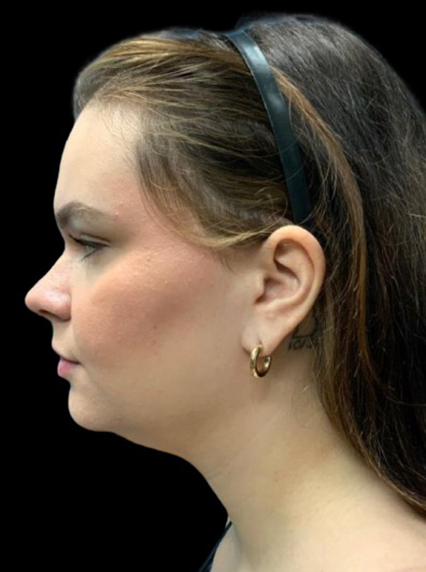 Profile view of a woman highlighting facial contours, showcasing Lentz Plastic Surgery results.