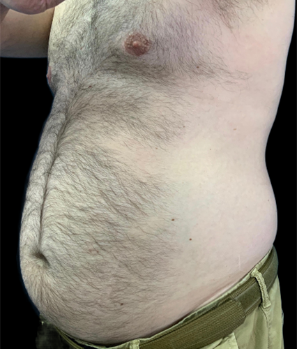 Male torso highlighting abdominal area for plastic surgery consultation.