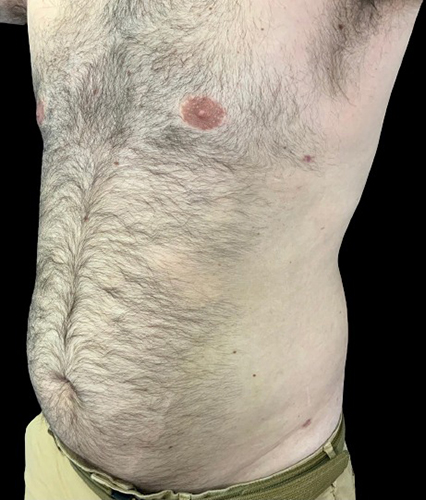 Male torso highlighting skin texture and contours, relevant for plastic surgery insights.