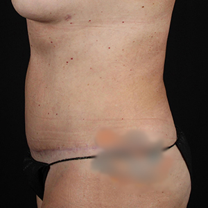Post-operative side view showcasing Lentz Plastic Surgery's body contouring results.