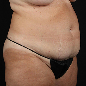 Before and after body contouring results showcasing improved silhouette.