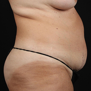 Before and after body contouring results showcasing improved silhouette.