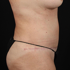 Side view of post-surgery abdomen highlighting Lentz Plastic Surgery results.