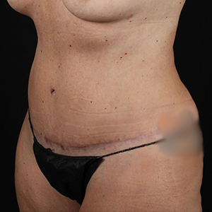 Before and after body contouring results showcasing Lentz Plastic Surgery expertise.