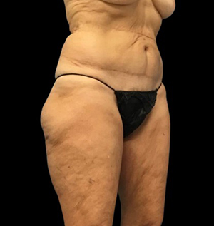 Before and after body contouring results showcasing improved silhouette.