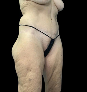 Body contouring results highlighting skin texture and shape.