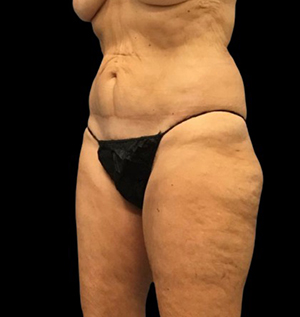 Realistic body model highlighting contouring techniques at Lentz Plastic Surgery.