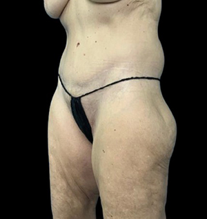 Realistic body model highlighting surgical results at Lentz Plastic Surgery.