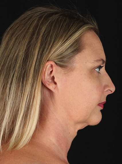 right side view after liposuction